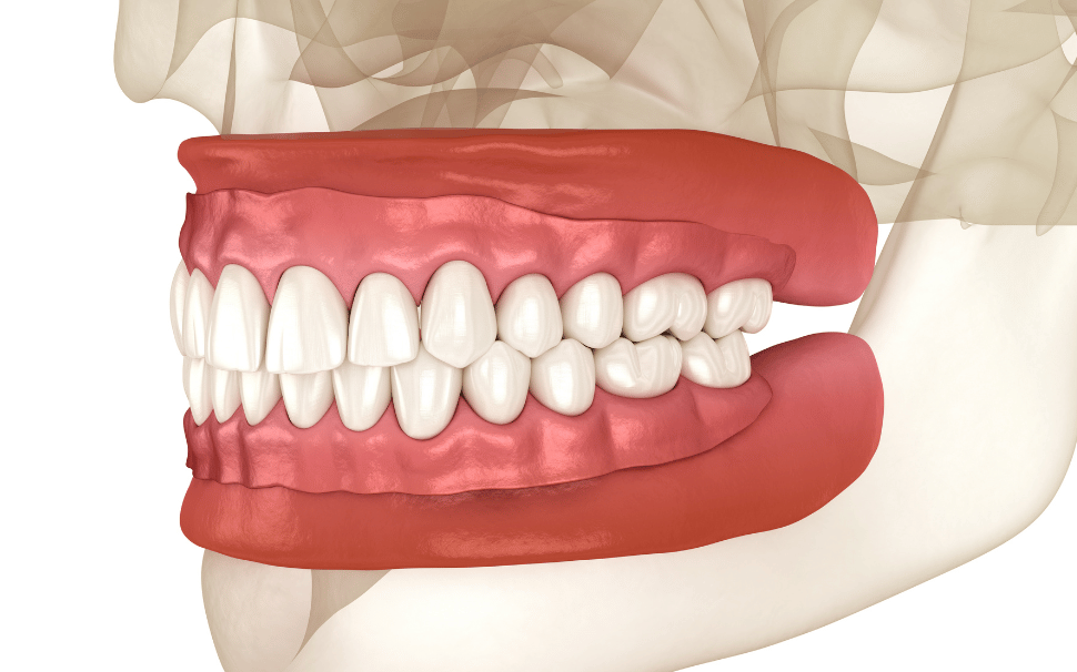  Types of Fillings 