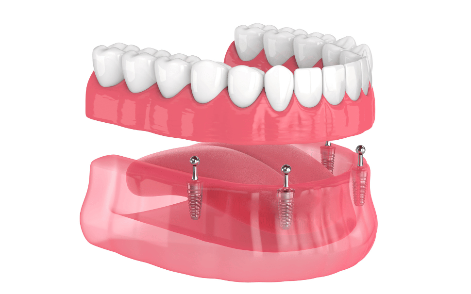  Types of Fillings 