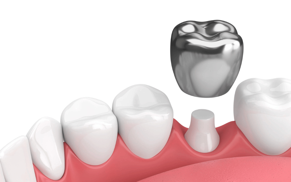  Types of Fillings 