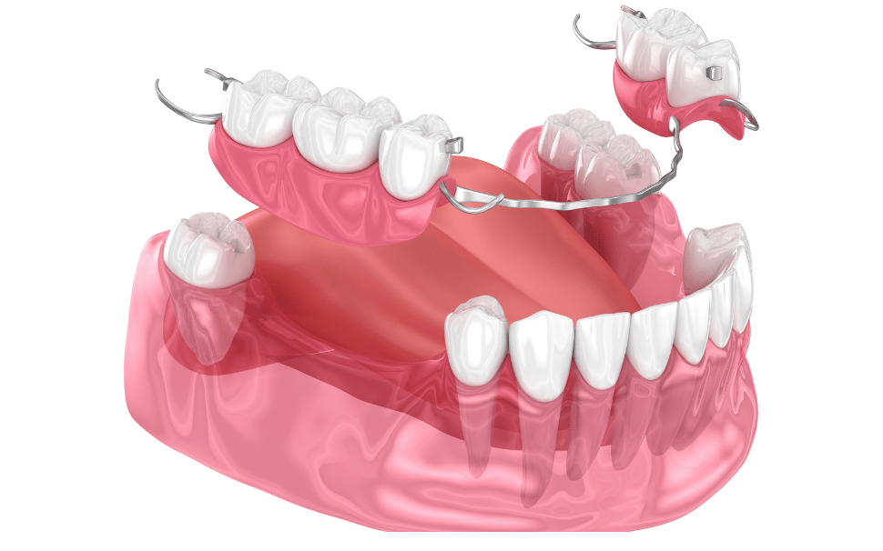  Types of Fillings 