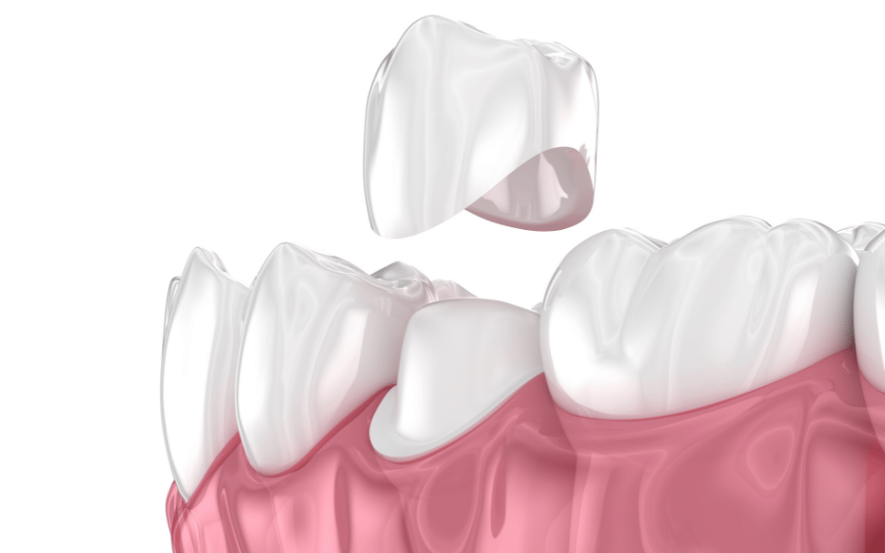  Types of Fillings 