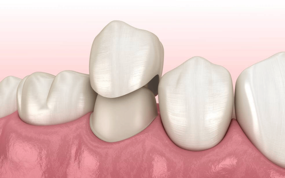  Types of Fillings 