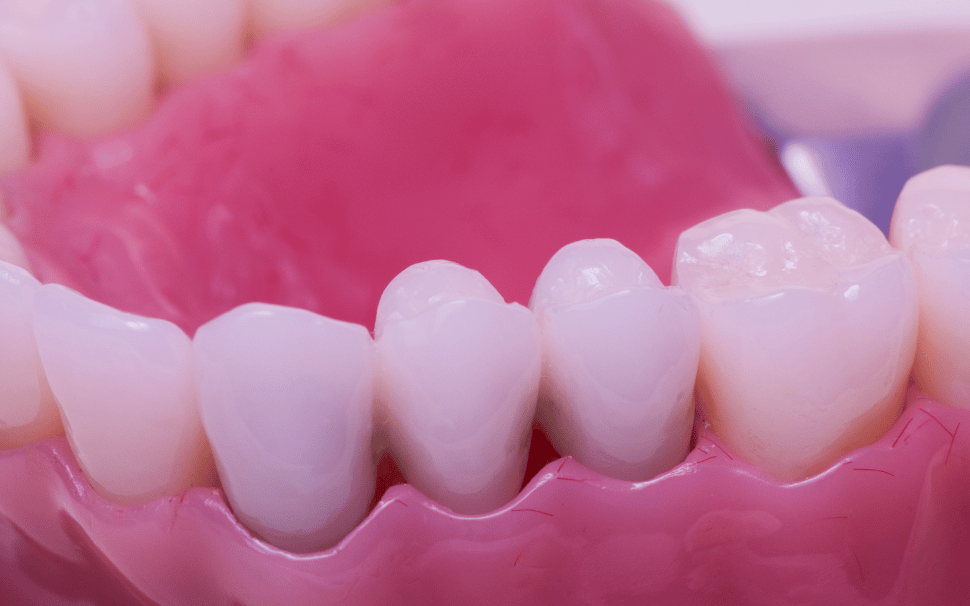  Types of Fillings 