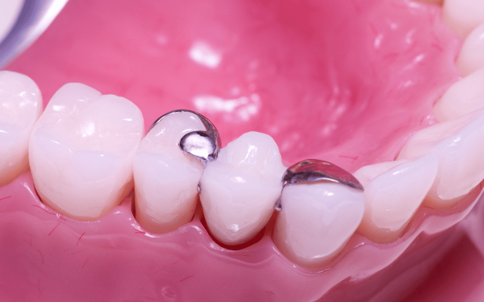  Types of Fillings 