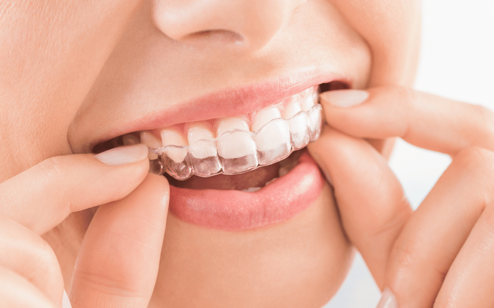  Types of Fillings 