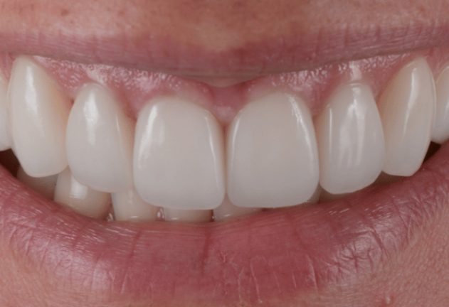 After - Pearl Dental Care