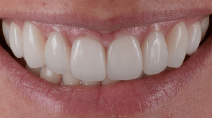 After - Pearl Dental Care