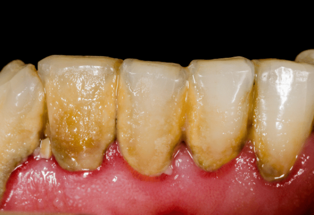 Before - Pearl Dental Care