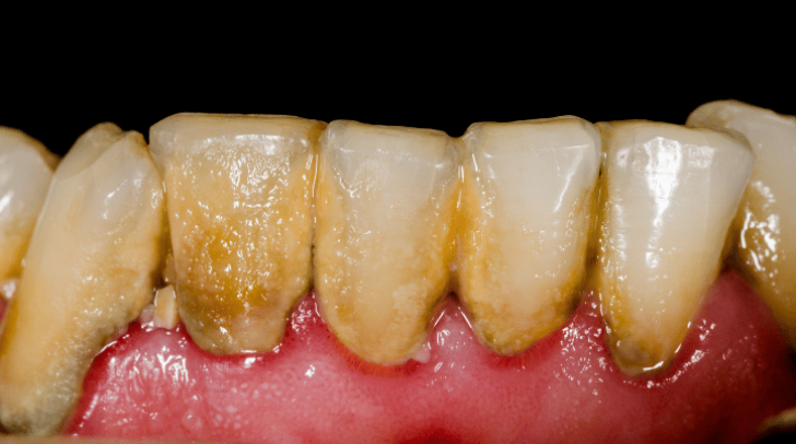 Before - Pearl Dental Care