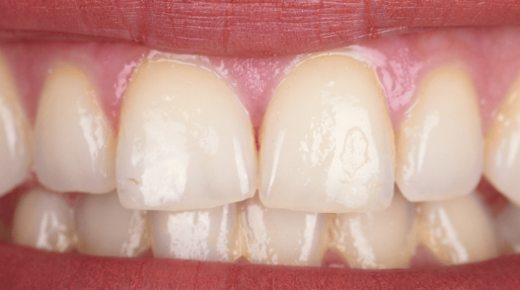 Before - Pearl Dental Care