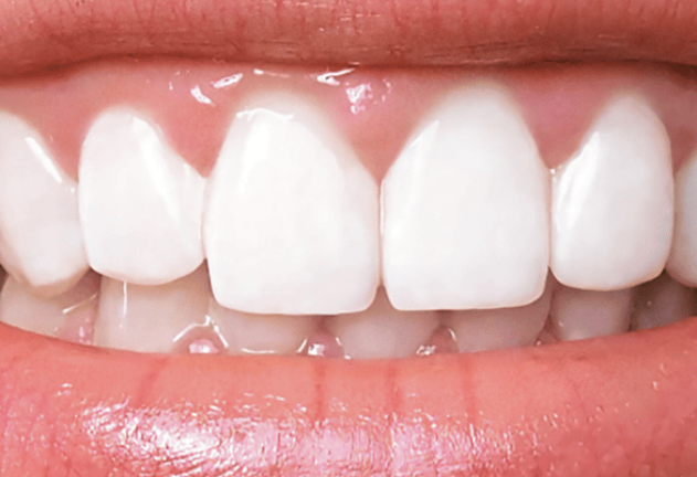 After - Pearl Dental Care