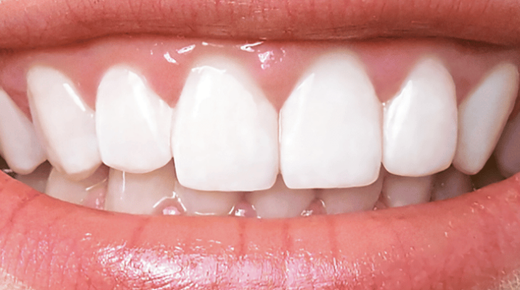 After - Pearl Dental Care