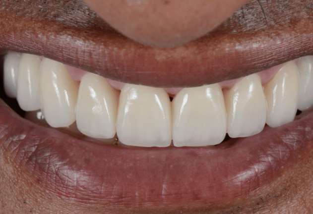 After - Pearl Dental Care