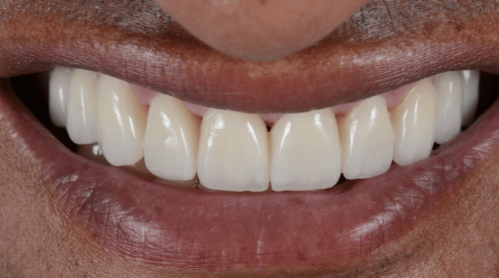 After - Pearl Dental Care